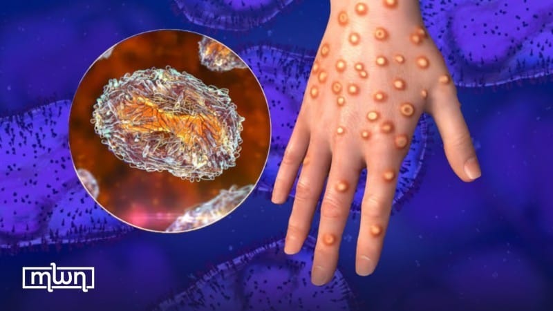 Morocco Confirms Monkeypox Case in Marrakech
