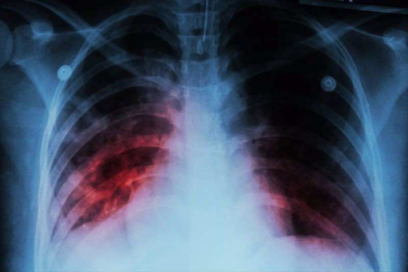 Over Half of New Tuberculosis Cases in Morocco Affect Organs Beyond Lungs