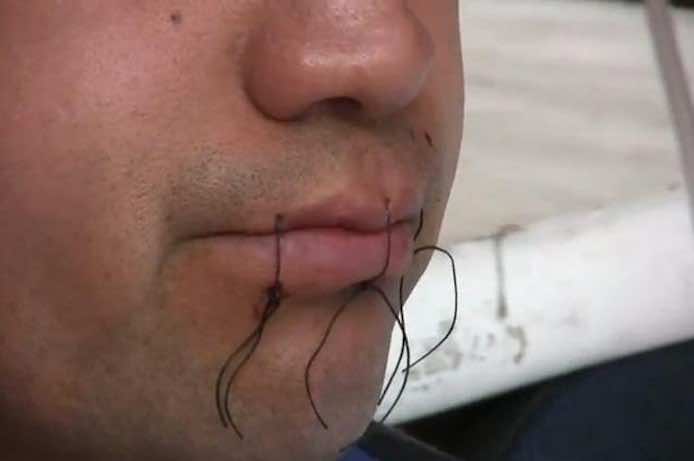 Moroccan Asylum-Seeker in France Sews Lips in Hunger Strike