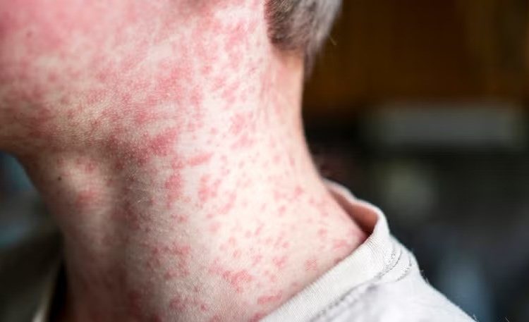 measles on an adult