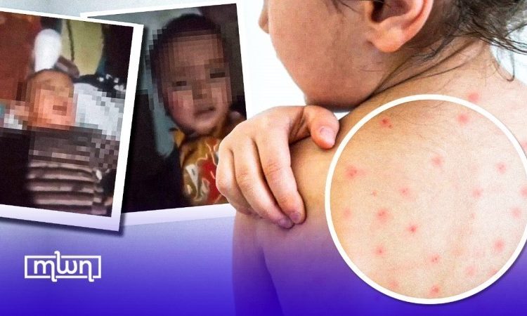 measles outbreak in Morocco.