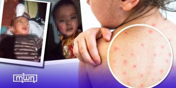 Morocco is facing a surge in measles cases