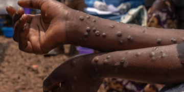 Sierra Leone confirmed two Mpox cases in four days