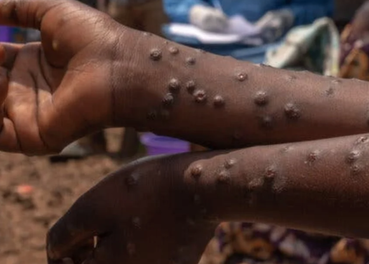 Sierra Leone confirmed two Mpox cases in four days