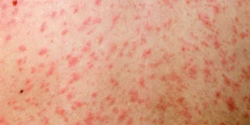 Measles