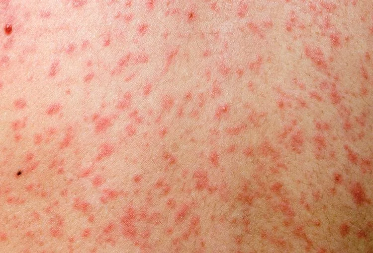 Measles