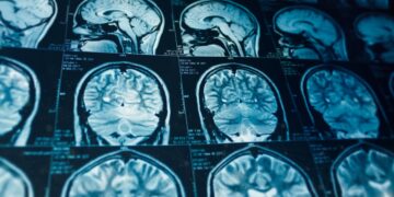 MRI Scan