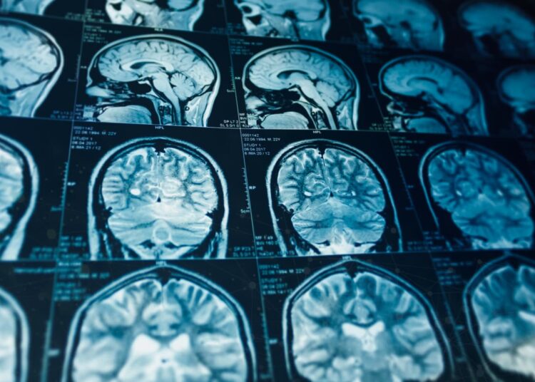 MRI Scan