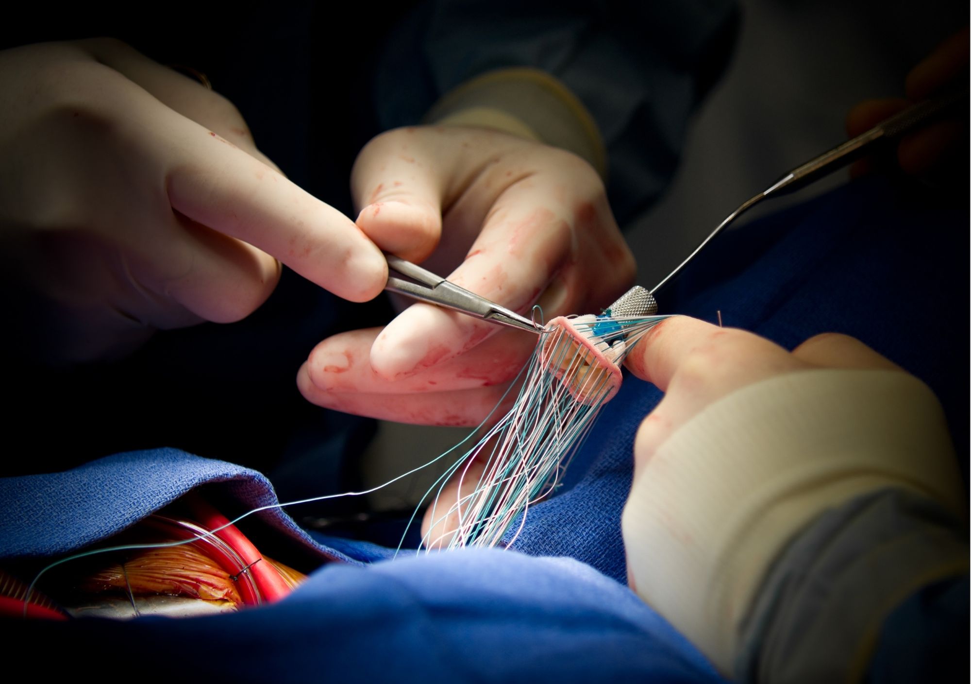 Moroccan Hospital Performs First Catheter-Based Pulmonary Valve Replacement