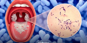 Morocco Reports Two Family Clusters of Diphtheria in Souss-Massa